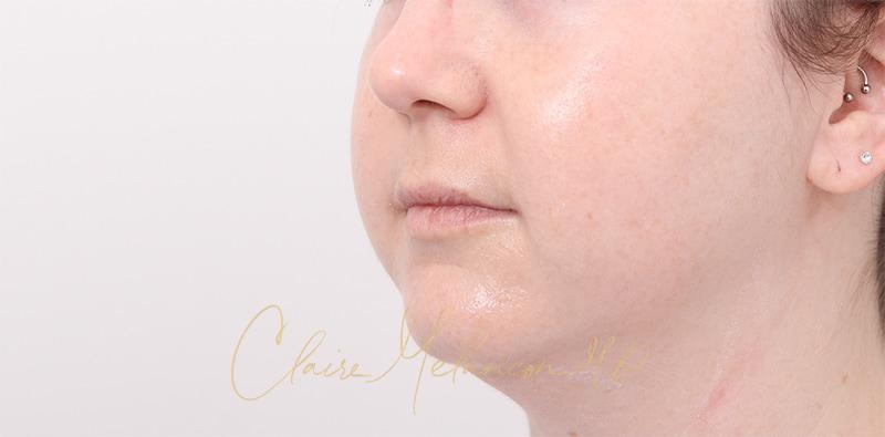 Buccal Fat Removal Before & After Photo