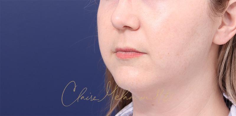 Buccal Fat Removal Before & After Photo