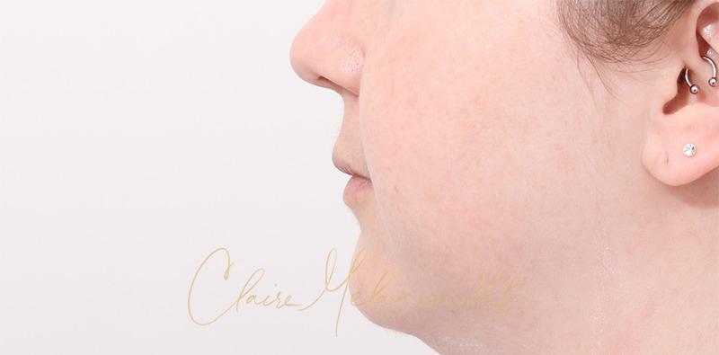 Buccal Fat Removal Before & After Photo