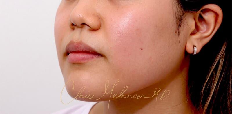 Buccal Fat Removal Before & After Photo