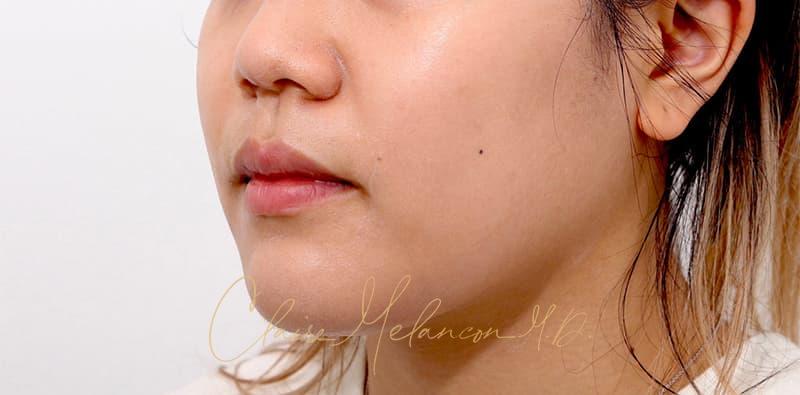 Buccal Fat Removal Before & After Photo