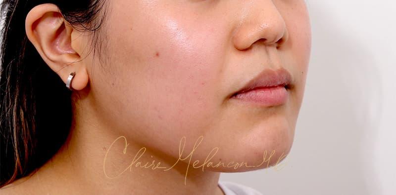 Buccal Fat Removal Before & After Photo