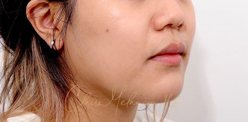 Buccal Fat Removal Before & After Photo