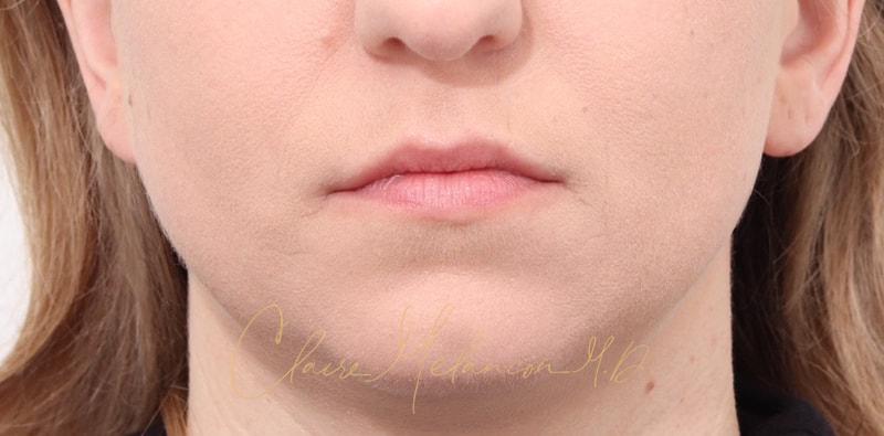 Chin Implant Before & After Photo