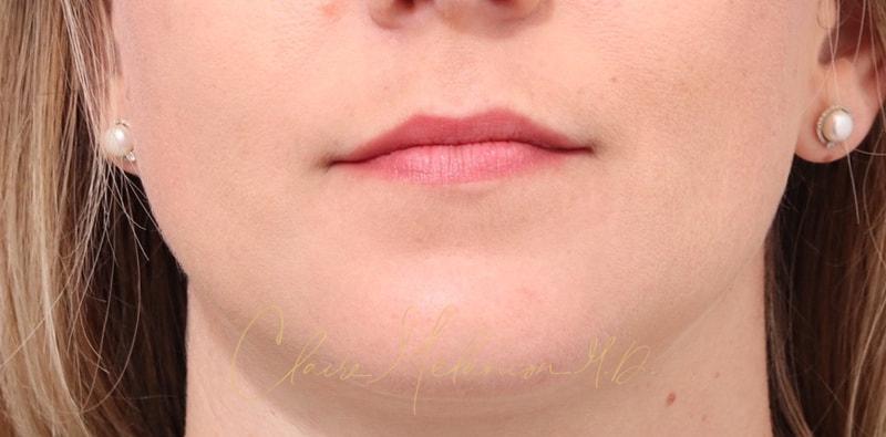 Chin Implant Before & After Photo