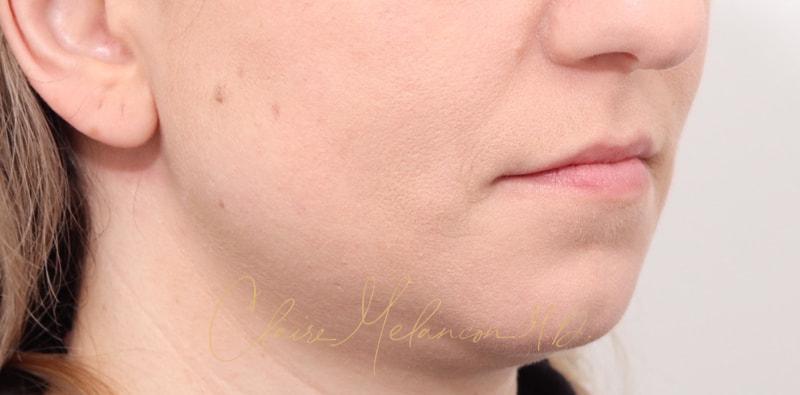 Chin Implant Before & After Photo
