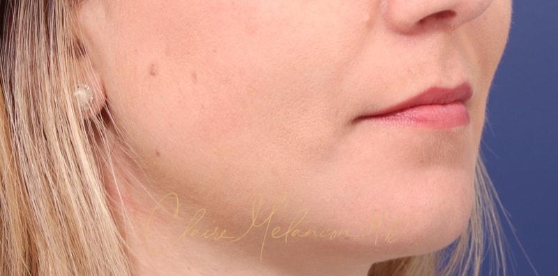 Chin Implant Before & After Photo