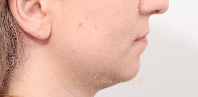 Chin Implant Before & After Photo