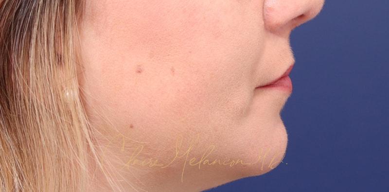 Chin Implant Before & After Photo