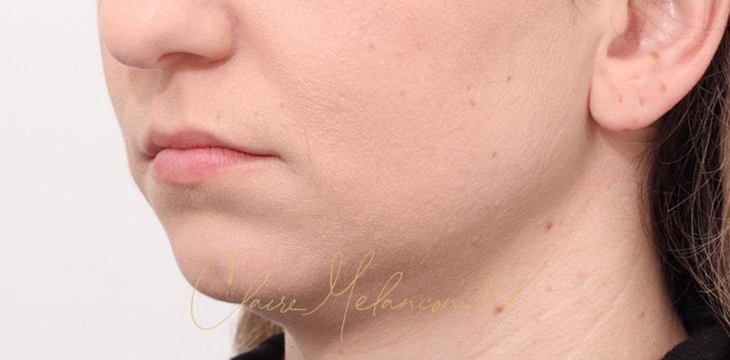 Chin Implant Before & After Photo