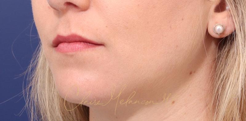 Chin Implant Before & After Photo