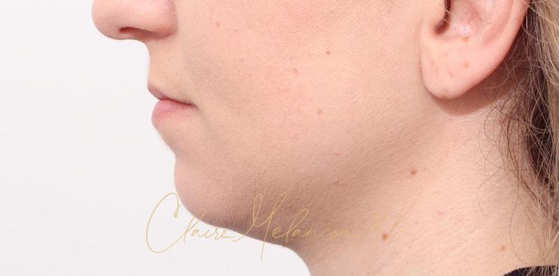 Chin Implant Before & After Photo
