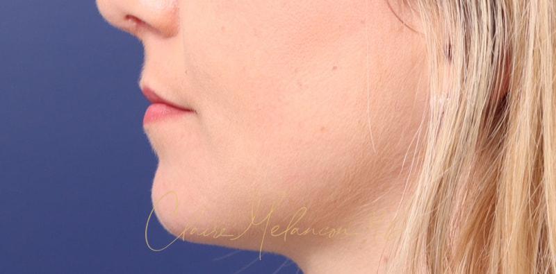 Chin Implant Before & After Photo