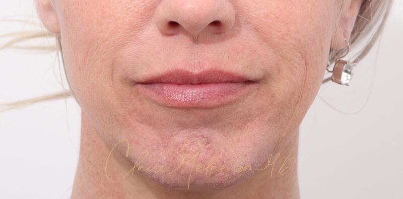Chin Implant Before & After Photo