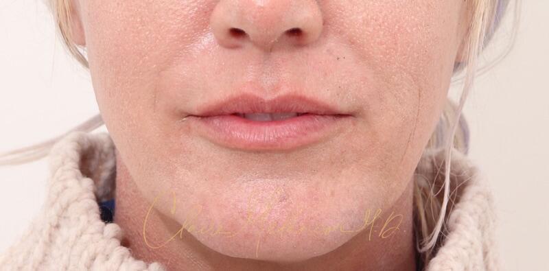 Chin Implant Before & After Photo