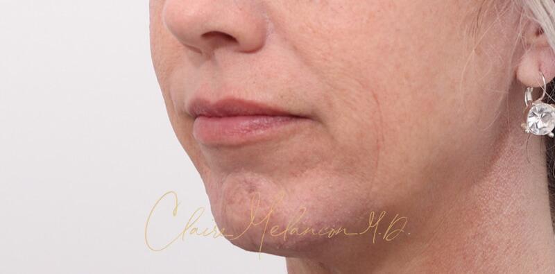 Chin Implant Before & After Photo