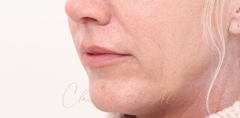 Chin Implant Before & After Photo