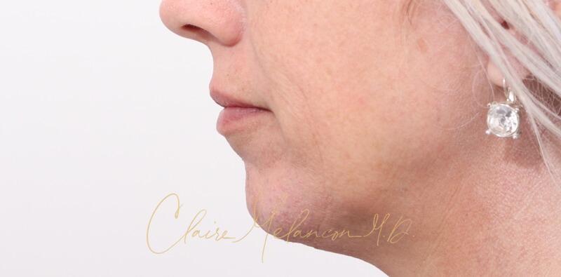 Chin Implant Before & After Photo