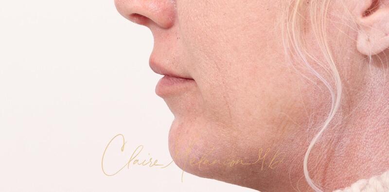 Chin Implant Before & After Photo