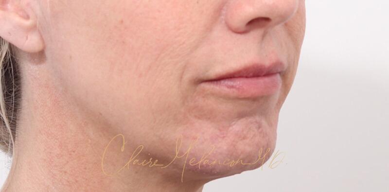 Chin Implant Before & After Photo