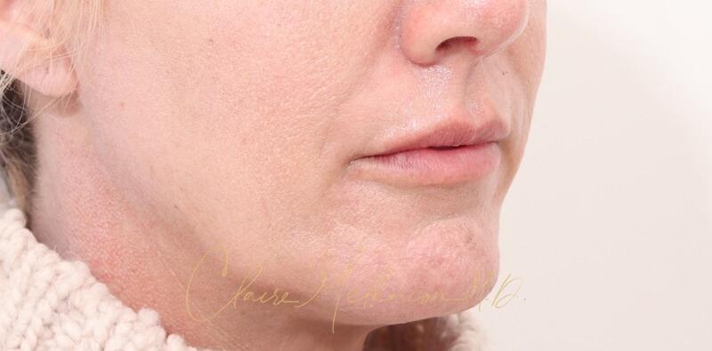 Chin Implant Before & After Photo