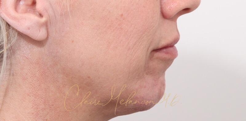 Chin Implant Before & After Photo