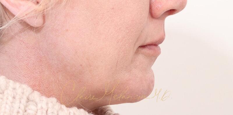Chin Implant Before & After Photo