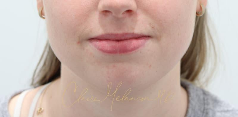 Chin Implant Before & After Photo