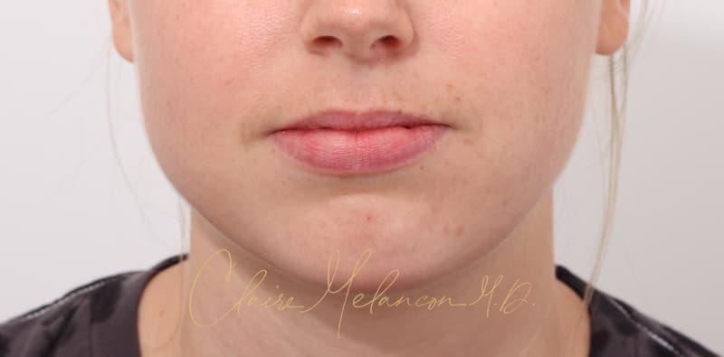 Chin Implant Before & After Photo
