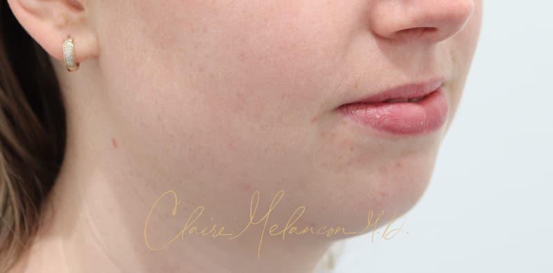 Chin Implant Before & After Photo