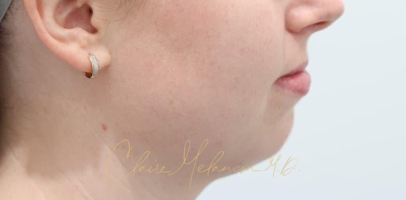 Chin Implant Before & After Photo