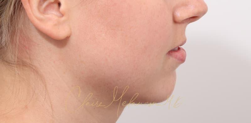 Chin Implant Before & After Photo