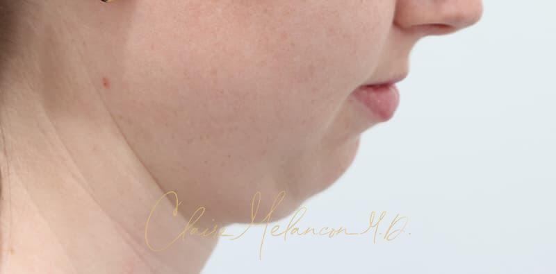 Chin Implant Before & After Photo