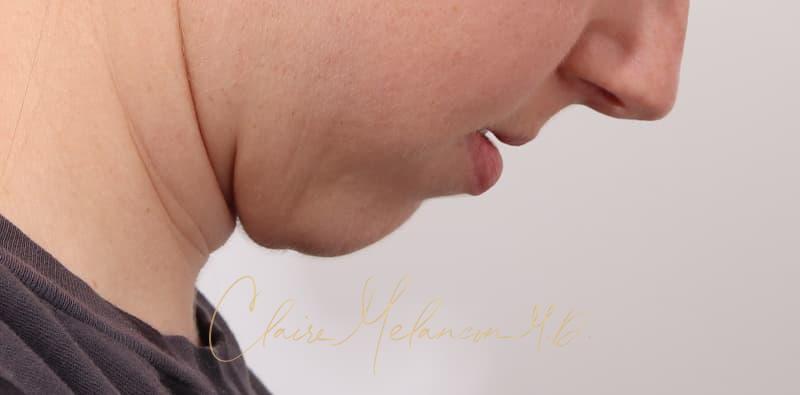 Chin Implant Before & After Photo