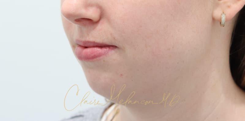 Chin Implant Before & After Photo