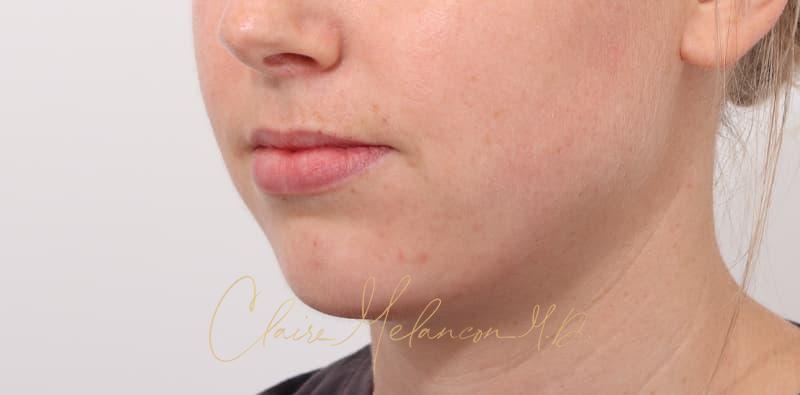 Chin Implant Before & After Photo