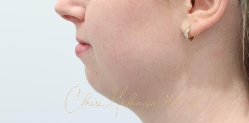 Chin Implant Before & After Photo