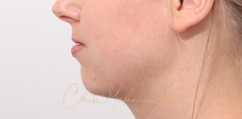 Chin Implant Before & After Photo