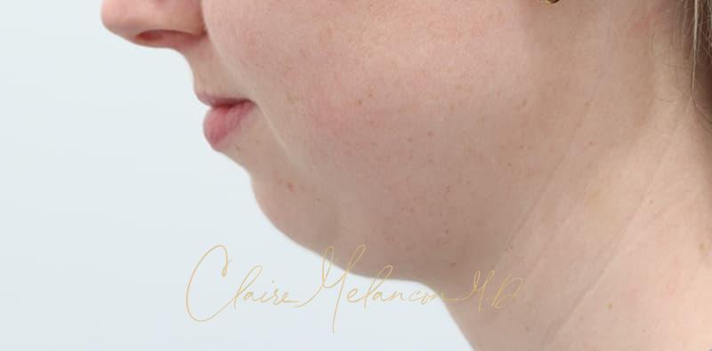 Chin Implant Before & After Photo