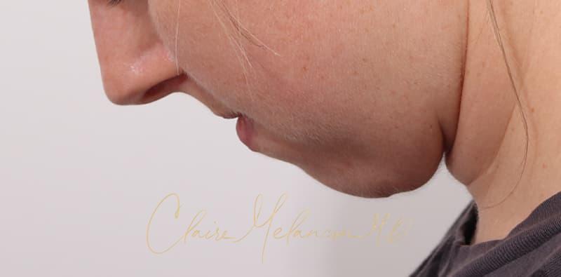Chin Implant Before & After Photo