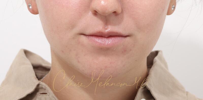 Chin Implant Before & After Photo