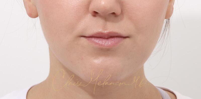Chin Implant Before & After Photo