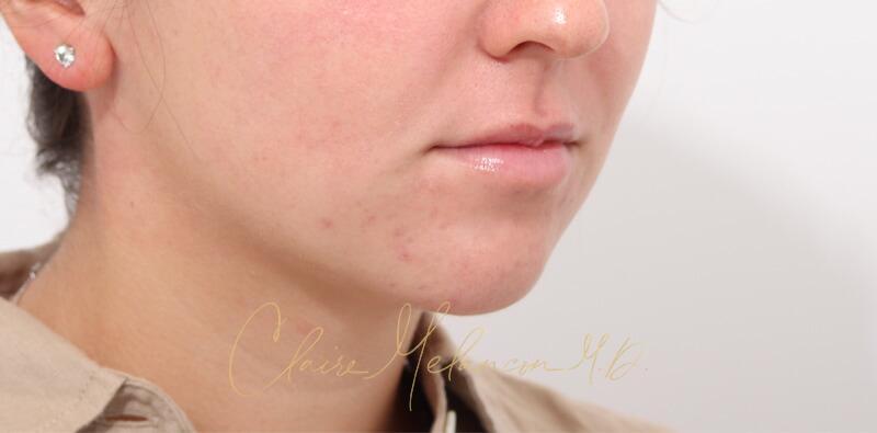 Chin Implant Before & After Photo