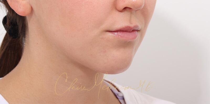 Chin Implant Before & After Photo