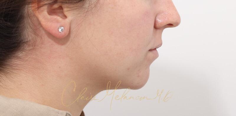 Chin Implant Before & After Photo