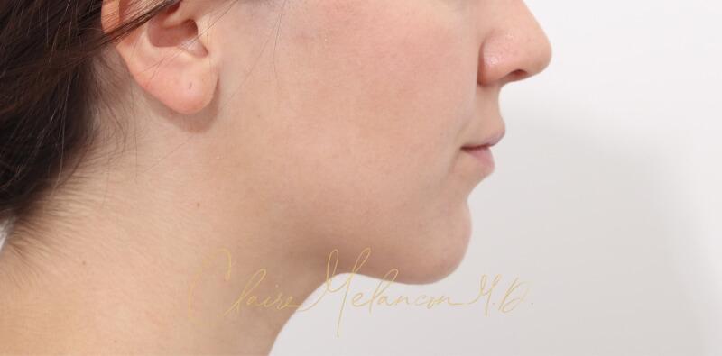 Chin Implant Before & After Photo