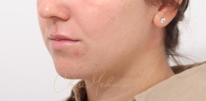 Chin Implant Before & After Photo