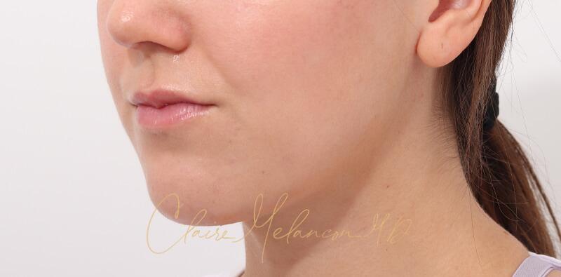 Chin Implant Before & After Photo