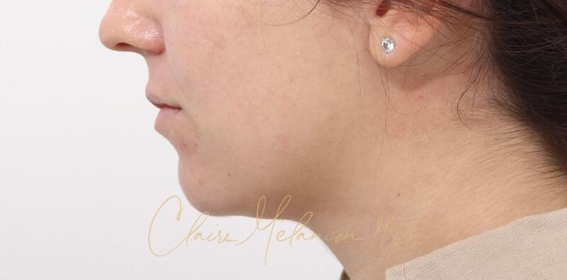 Chin Implant Before & After Photo