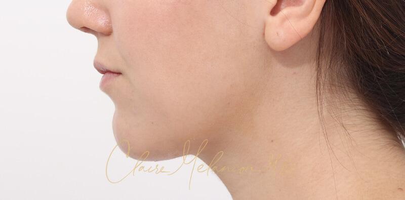 Chin Implant Before & After Photo